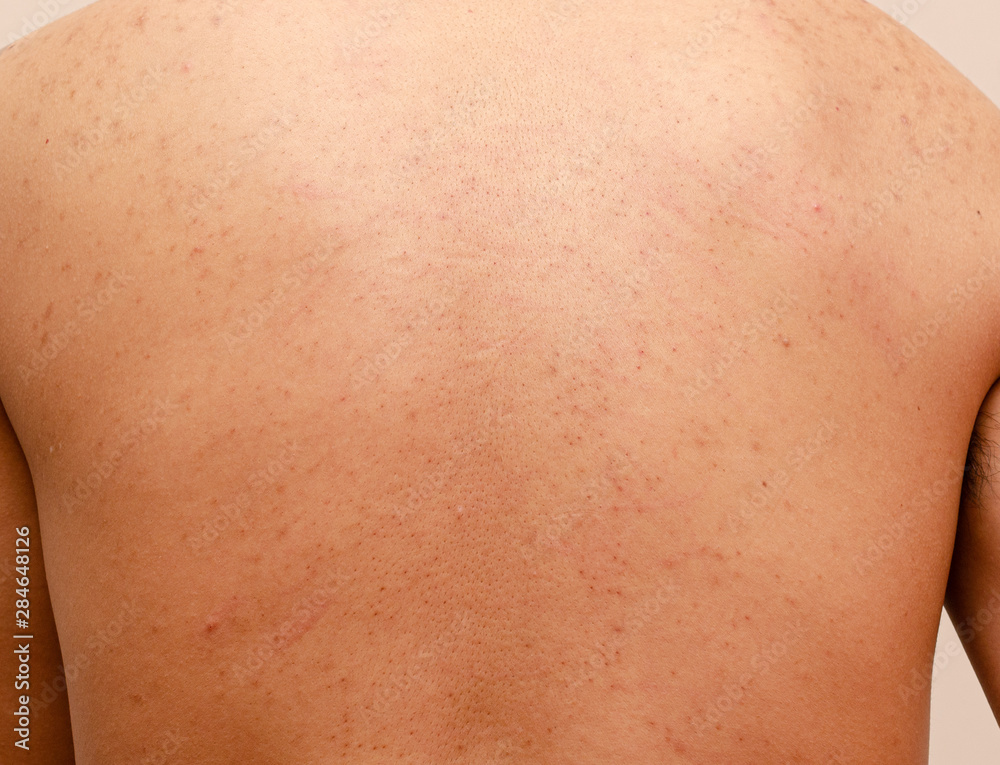 The back of an Asian man with acne The back of an Asian man with acne