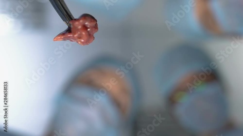 Surgeons removing liver tumor during hospital operation, patient pov, medicine