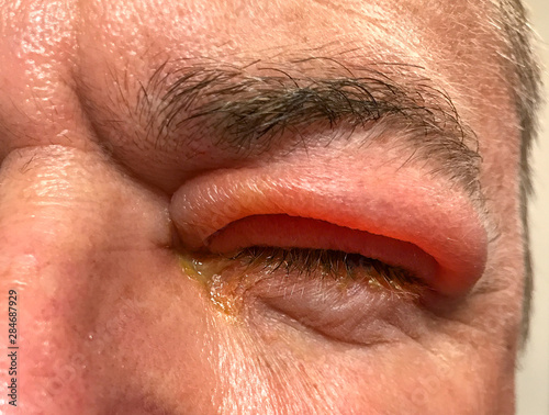 Detail of badly swollen upper eyelid of a man