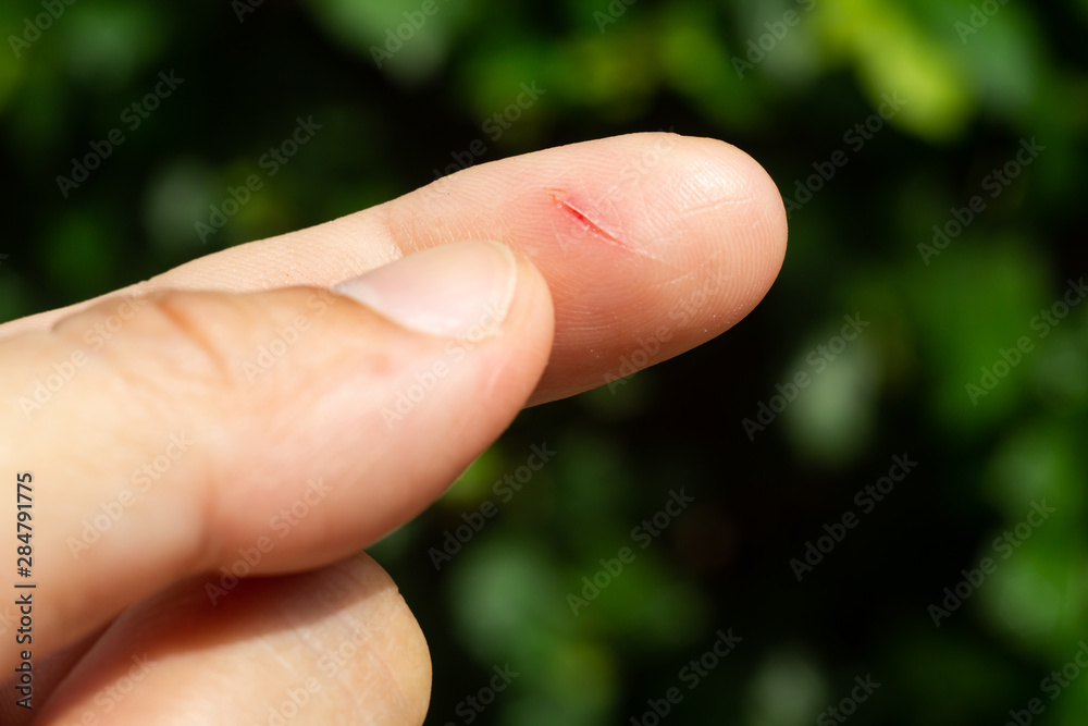 Woman has been cut index finger and scar skin on hand, Close up & Macro shot, Asian Body skin part, Healthcare concept, Bokeh green garden background Woman has been cut index finger and scar skin on hand, Close up & Macro shot, Asian Body skin part, Healthcare concept, Bokeh green garden background