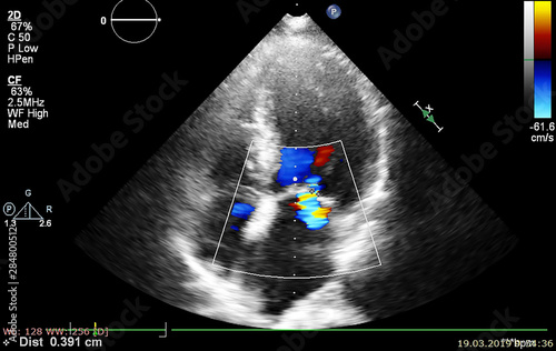 Screen of echocardiography (ultrasound) machine.