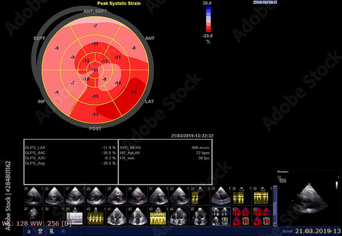 Screen of echocardiography (ultrasound) machine.