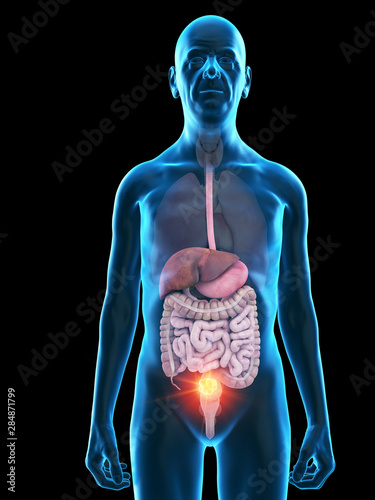 3d rendered medically accurate illustration of an old mans digestive tumor photo