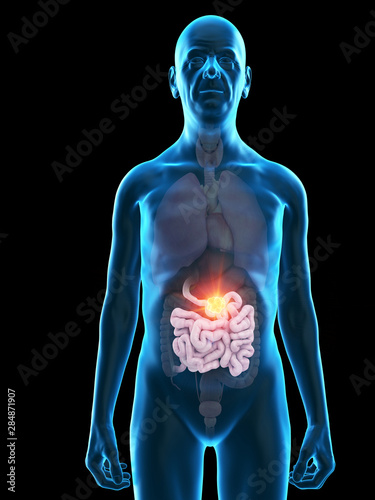 3d rendered medically accurate illustration of an old mans small intestine tumor