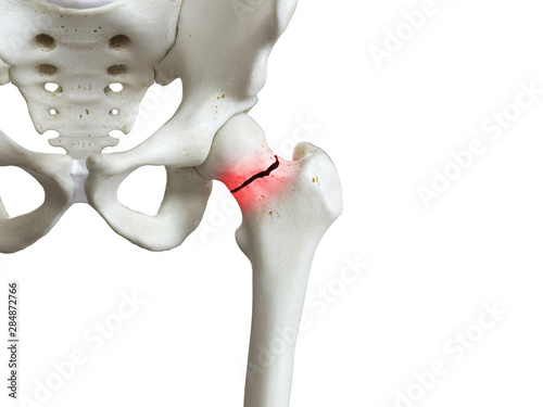 Canvas-taulu 3d rendered medically accurate illustration of a broken femur neck