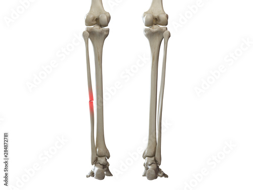 3d rendered medically accurate illustration of a broken fibula photo