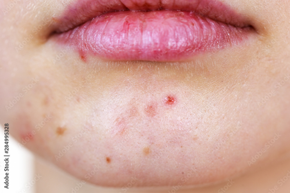 Obraz premium Female face with acne skin problem