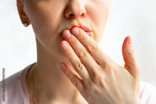 Lower part part of woman face with Red bubbles of virus herpes on her lips, she hides with her palm on white background, Zoster, Cold, Medicine, Treatment. Horizontal