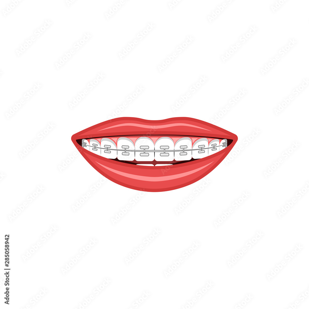 Wide female smile with teeth and braces sign for orthodontist cabinet medical illustration