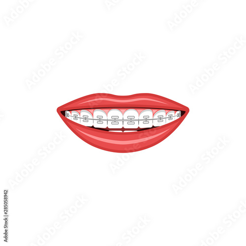 Wide female smile with teeth and braces sign for orthodontist cabinet medical illustration