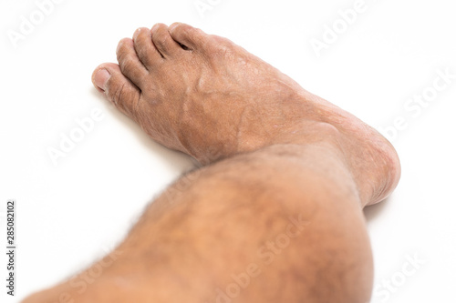 Asian man foot brown and dry skin