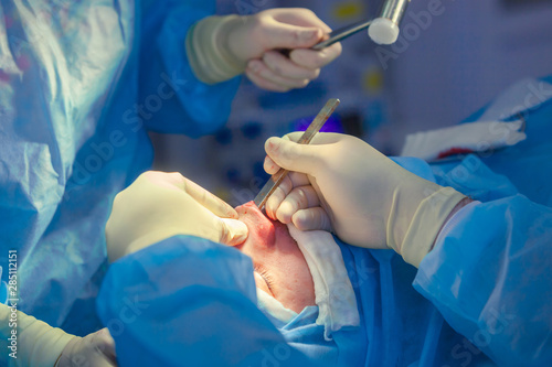 Surgeon and his assistant performing cosmetic surgery on nose in hospital operating room. Nose reshaping, augmentation. Rhinoplasty. Hammer.