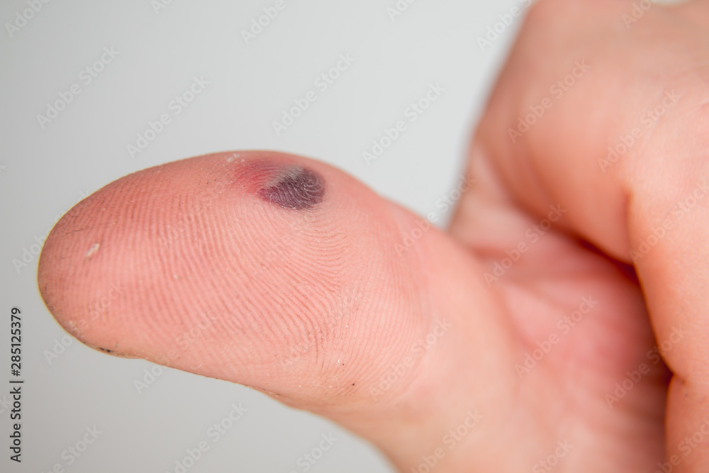 blood-blister-under-the-thumb-skin-caucasian-young-man-finger-on-white