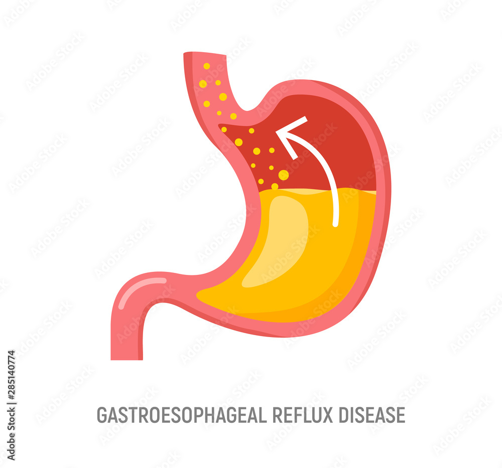 Gastroesophageal reflux disease. Stomach GERD heartburn esophagus medical illustration Gastroesophageal reflux disease. Stomach GERD heartburn esophagus medical illustration