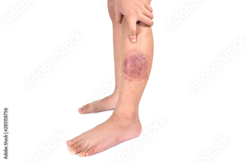 Ringworm infection or Tinea corporis on skin isolated on white background,  Dermatophytosis on skin isolated