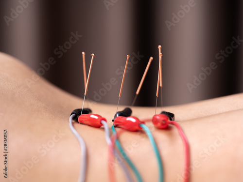 Obraz na plátne woman undergoing acupuncture treatment with electrical stimulator on back
