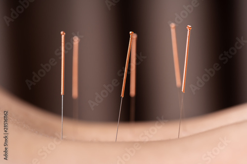 woman undergoing acupuncture treatment on back