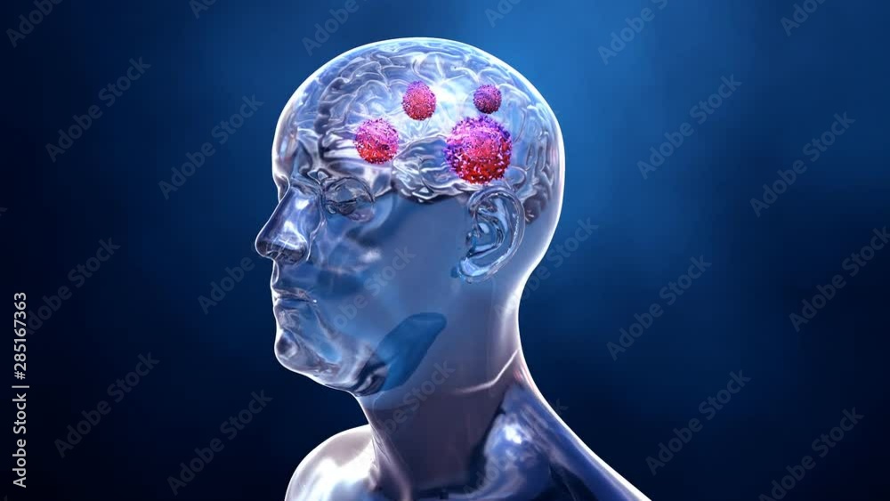 Brain cancer or brain tumor
