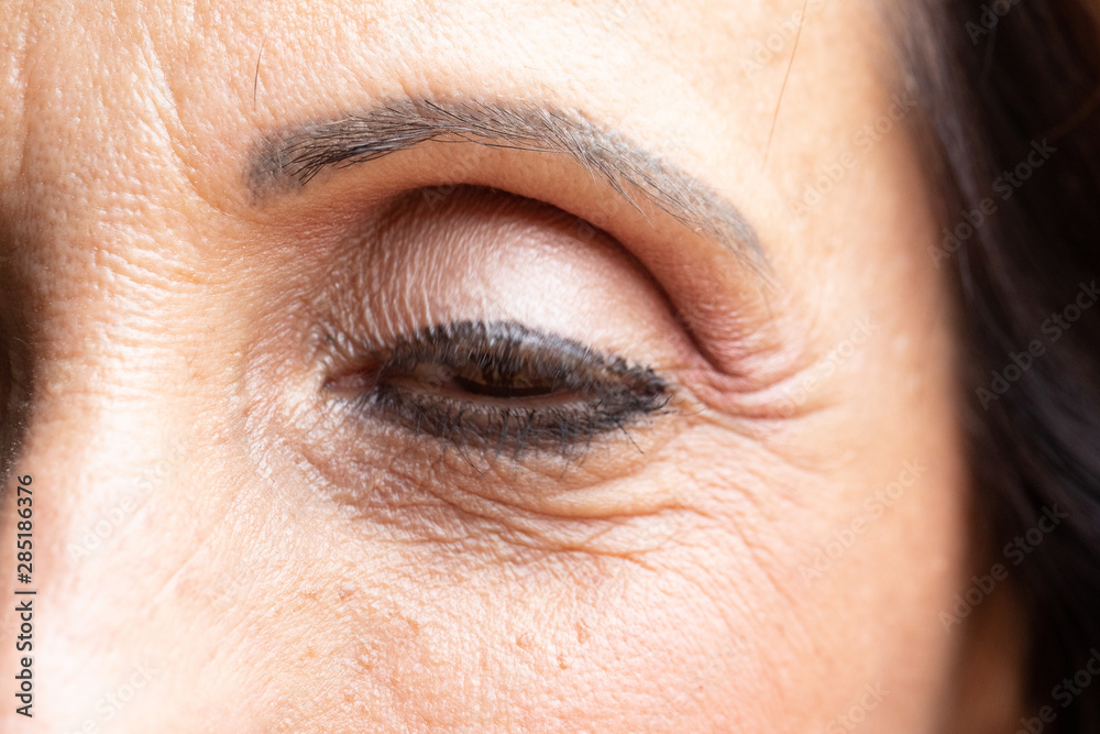 Obraz premium Closeup of female eye with ptosis: drooping eyelid, amblyopia condition called lazy eye.