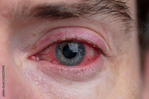 Foto Close up of a severe bloodshot eye