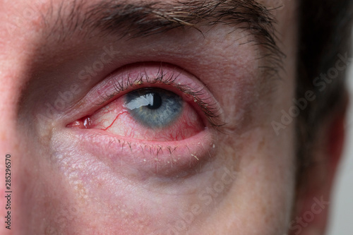 Tableau sur toile Close up of a severe bloodshot eye