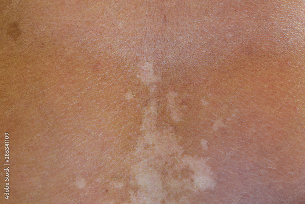 Sunburn on the skin of the back. Exfoliation, skin peels off. Dangerous sun tan