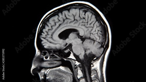 Stop motion animation made with sagittal MRI scans of a human brain. photo