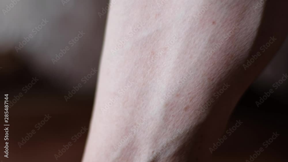 Varicose veins. Female foot with varicose veins, close up Varicose veins. Female foot with varicose veins, close up