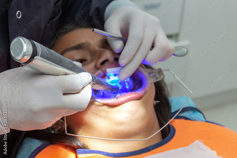 Dentist placing braces on a teenage girl with ultraviolet light Stock