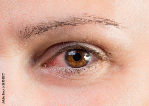 Konstfotografi Close up of human eye of woman suffering with ocular rosacea, evident redness du