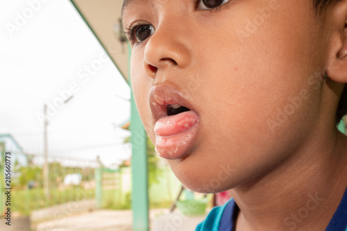 Hand foot mouth syndrome