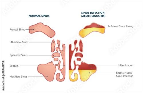 Medical infographic of sinus and human nasal anatomy.