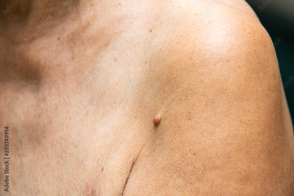 Naklejka premium Brown mole on senior woman's brachium, Medicine, Close up