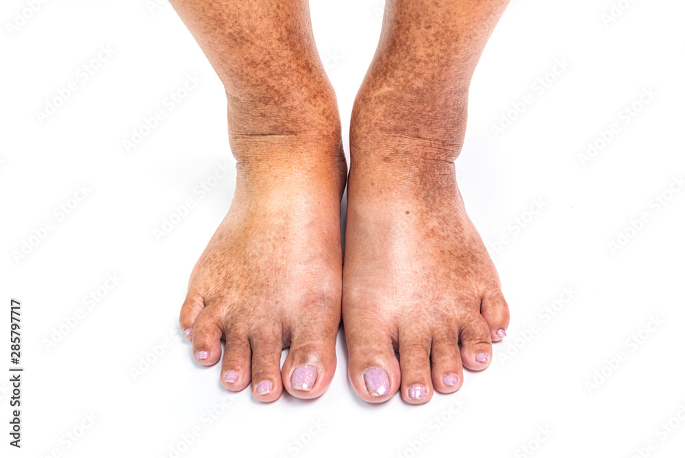 closeup skin at legs show mottled skin caused by Diabetes Stock Photo |  Adobe Stock