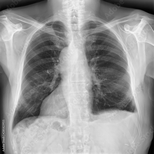 X-Ray Image Of Human Chest - TB screening