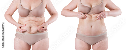 Tummy tuck, flabby skin on a fat belly, plastic surgery concept