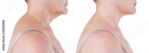 Photography Skin rejuvenation on the neck, before after anti aging concept, wrinkle treatmen