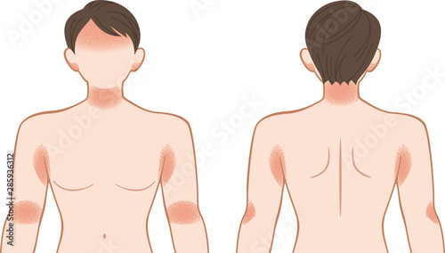 あせも・湿疹　上半身　男性