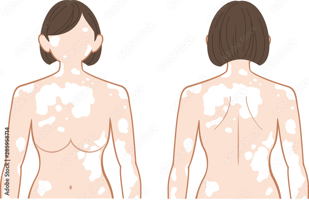 白斑 上半身 女性 白斑 上半身 女性