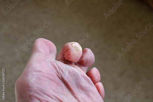 hammerr toe deformaty of the foot