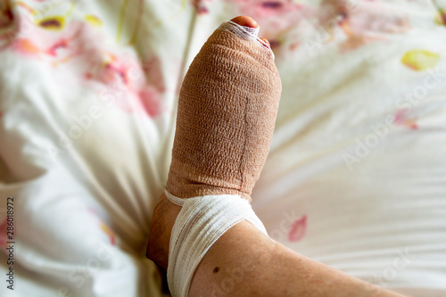 Bandaged foot a few hours after bunion and hammertoe surgery on the right foot of a woman in her 60's.