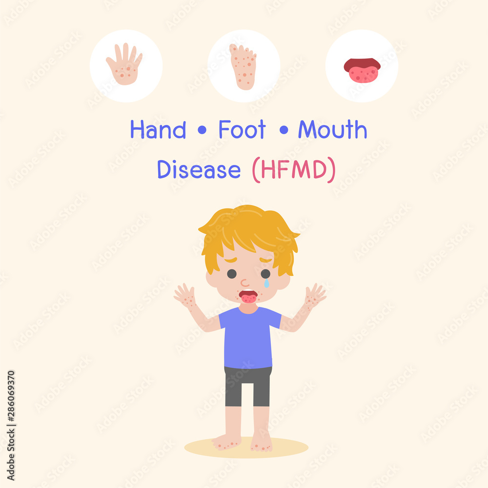 Children infected, Boy have a Hand Foot Mouth Disease, HFMD in rain season, Medical Health care concept, cartoon character vector Info-graphic. Children infected, Boy have a Hand Foot Mouth Disease, HFMD in rain season, Medical Health care concept, cartoon character vector Info-graphic.