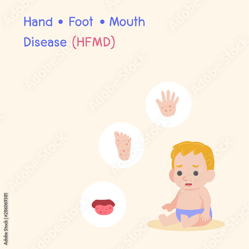 Children infected, Boy have a Blister Hand Foot Mouth Disease, HFMD in rain season, Medical Health care concept, cartoon character vector Info-graphic.