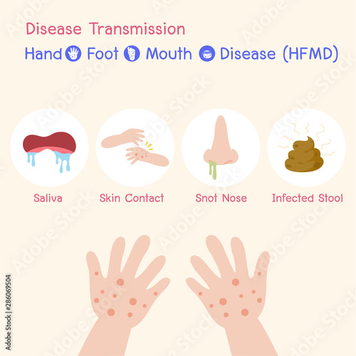 blister, baby, care, cartoon, cause, child, children, concept, contact, disease, enterovirus, fear, fever, finger, flu, foot, hand, headache, health, healthy, ill, illness, infected, infection, info g