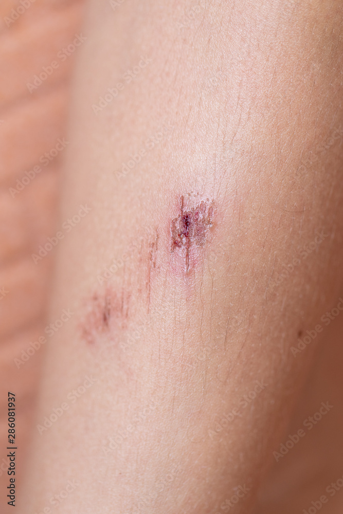 Closeup injured at leg, Fresh wounds from accident. 