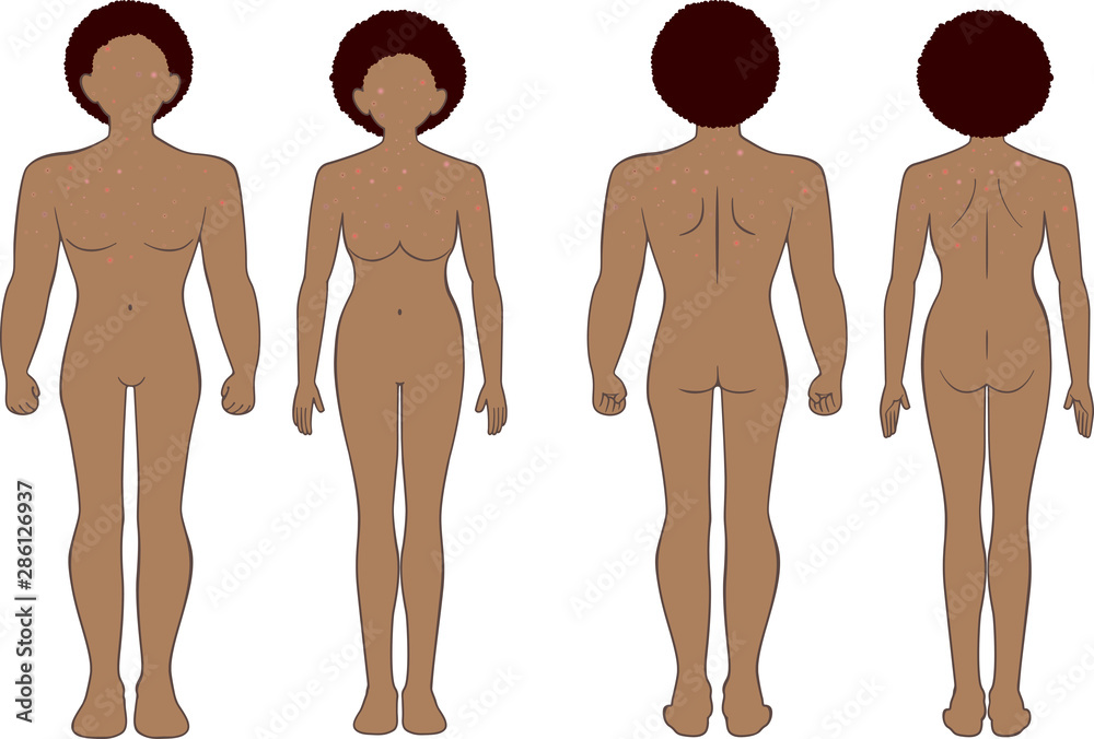 できもの 全身 男女 できもの 全身 男女