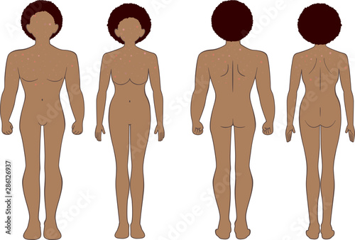 できもの　全身　男女