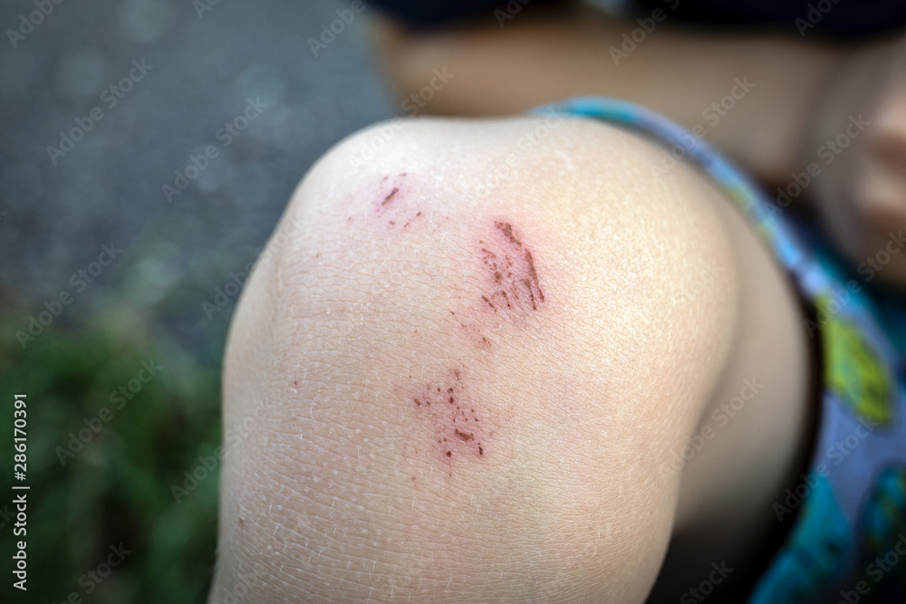 Fototapeta premium Scratched skin on the kid’s knee, injury after falling