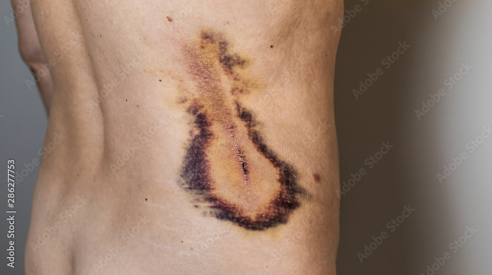 Fototapeta premium Large painful hematoma