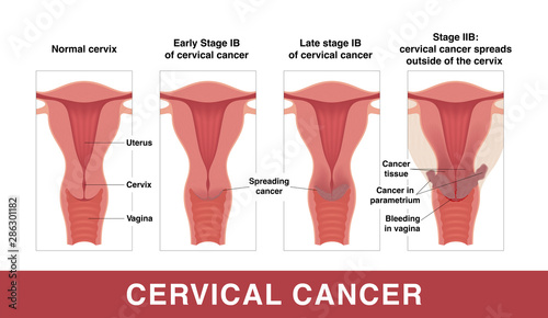 Cervical cancer. Three stages of cancer. Vector medical illustration with inscriptions. Female reproductive organs. Frontal view in a cut.
